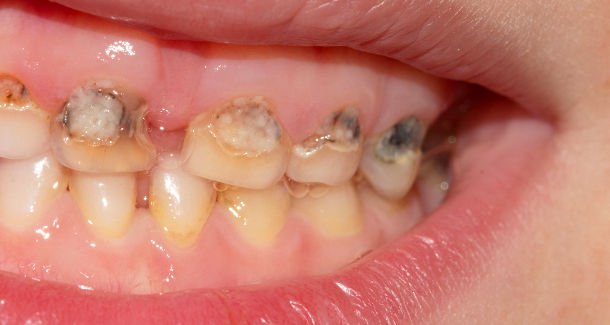 Хүүхдийн шүд хорхойтох өвчин